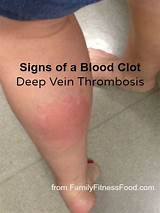 Images of Blood Clot In Foot Treatment At Home