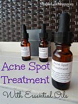 Images of Best Essential Oil For Acne Spot Treatment