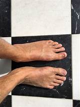 Tailor''s Bunion Surgery Recovery Pictures