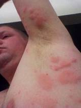Photos of Severe Allergic Skin Reaction Treatment
