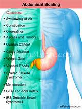 Pictures of Upper Abdominal Pain And Gas