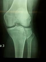 Broken Knee Cap Surgery Recovery Time