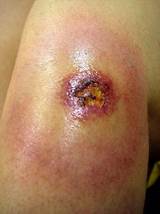 Images of Termite Bites Symptoms