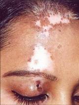 Pictures of Segmental Vitiligo Treatment