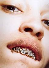 Silver Caps On Kids Teeth Images