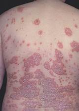 Pictures of What Is The Latest Treatment For Psoriasis