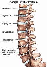 Cervical Spine Disc Bulge Treatment Pictures