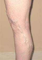 What Is A Varicose Vein Doctor Called