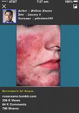Photos of Metronidazole Gel Rosacea Side Effects