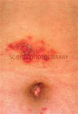 Severe Allergic Skin Reaction Treatment Photos
