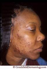 Pictures of Eczema Treatment African American Skin