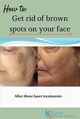 Pictures of Laser Treatment To Remove Brown Spots