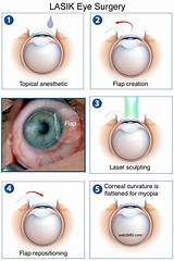 Articles On Lasik Eye Surgery