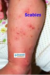 Scabies Home Remedies For Babies Images