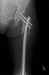 Pictures of Femur Fracture Recovery Time