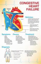 Traditional Treatment Of Heart Failure Pictures