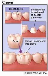 Images of Does Dental Insurance Cover Crowns