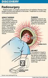 Side Effects From Gamma Knife Pictures