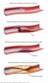 Stent Medical Definition Images