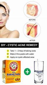 Pictures of Best Natural Acne Scar Treatment