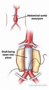 Aortic Aneurysm Stent Recovery Time Pictures