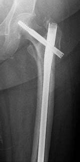 Photos of Femur Fracture Recovery Time