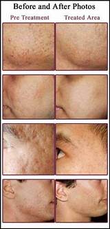 Images of In Home Chemical Peels Best Ones