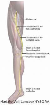 Nerve Block Knee Surgery Side Effects Images