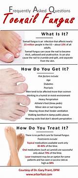 Foot Doctor For Nail Fungus Pictures