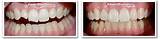 Images of Dental Bonding Before And After Pics