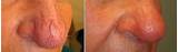 Spider Veins On Nose Laser Treatment Pictures