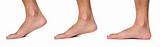 Pictures of What Is Flat Feet