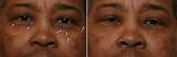 Laser Treatment For Acne Scars African American
