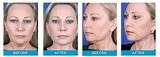 Skin Doctors Instant Facelift Reviews Pictures