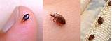 Kill Bed Bugs With Bleach Images