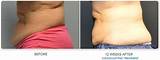 How Much Is A Coolsculpting Treatment