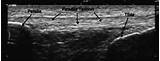 Ultrasound Core Muscles Images
