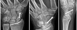 Pictures of Scaphoid Fracture Treatment Options