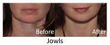 Jowl Muscle Exercises Pictures
