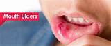 Celiac Mouth Sores Treatment Pictures