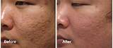 Best Acne Scar Doctor In The World Images