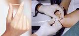 How Does Arm Implant Birth Control Work Photos