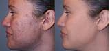 Laser Treatment For Acne Scars On Black Skin Pictures