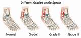 Pictures of Sprained Ankle Recovery Time Grade 3