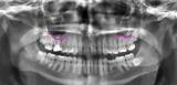 Can Tooth Implant Cause Sinus Problems