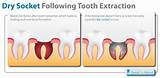 Images of Tooth Extraction Recovery Timeline