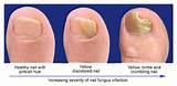 Images of Best Toe Fungus Medication