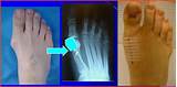Photos of Medication For Bunion Pain