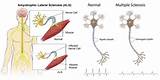 Symptoms Of Motor Neuron Disease Mayo Clinic Photos