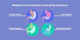 Medical Insurance That Covers Bariatric Surgery Pictures